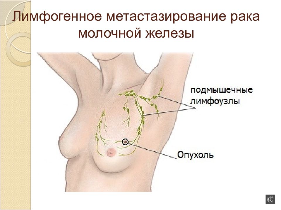 Метастазирование рака молочной железы схема