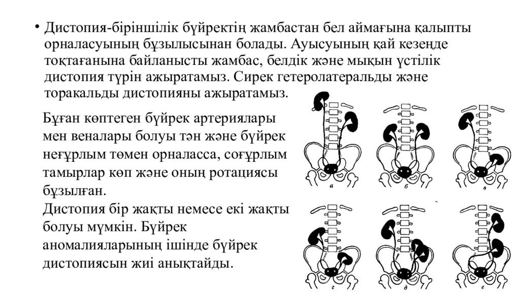 Дистопия почки. Дистопия почки классификация. Степени дистопии почки. Дистопия почки 1 степени.