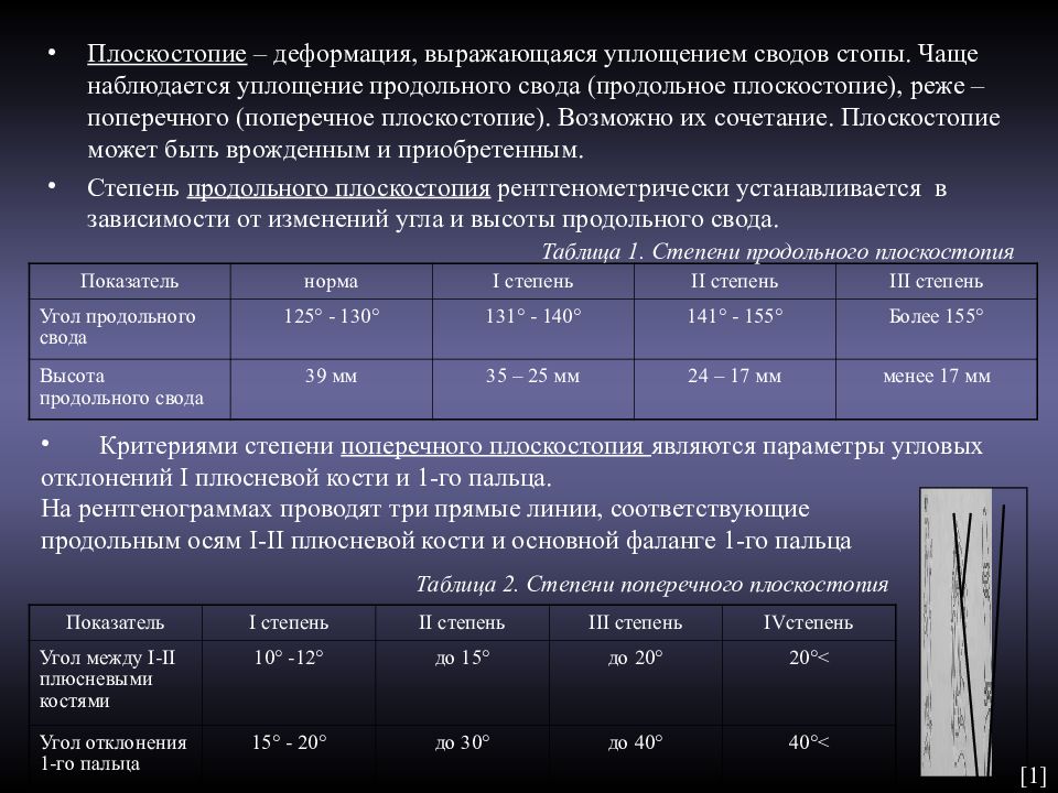 Результаты рентгена. Продольное плоскостопие рентген степени. Продольное плоскостопие рентген стадии. Поперечное плоскостопие рентген степени. Степени плоскостопия таблица.