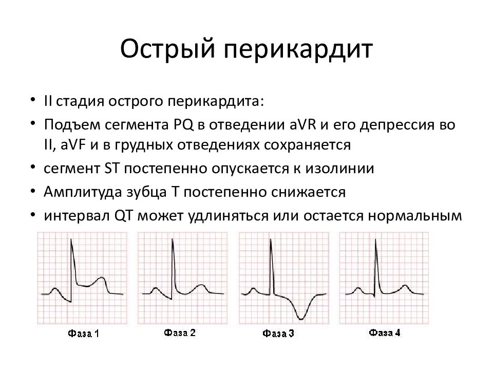 Экг признаки окс