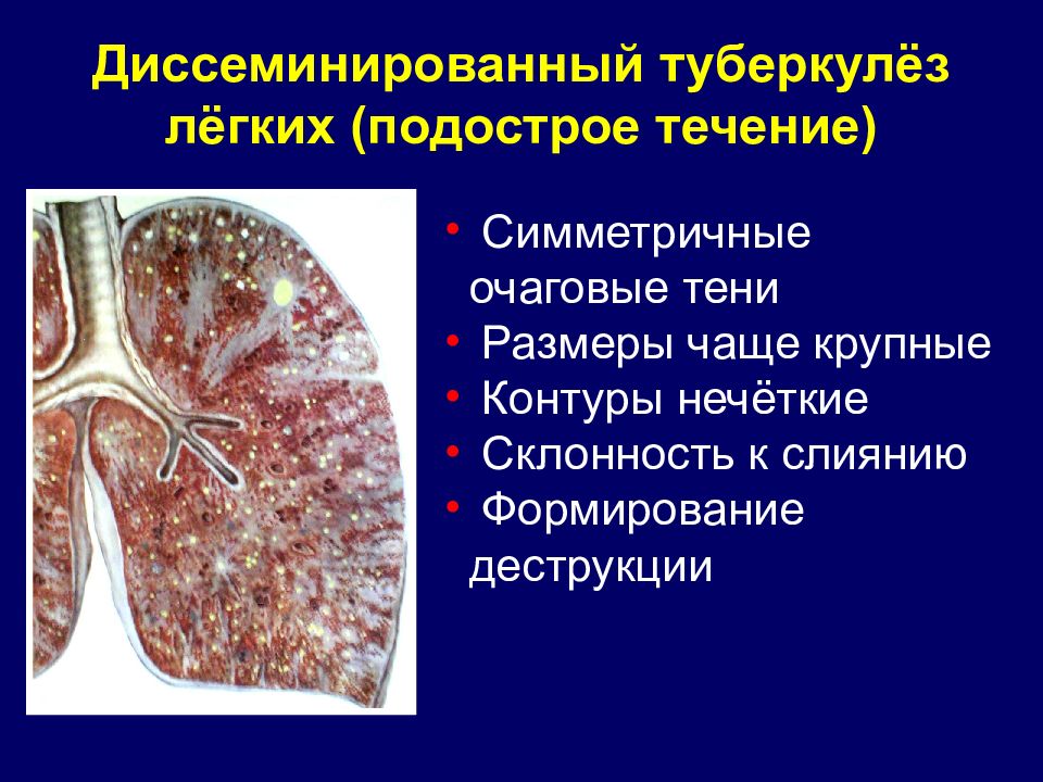 Лимфогенный туберкулез. Диссеминированный туберкулез патологическая анатомия. Диссеминированный острый диссеминированный туберкулез. Диссеминированный туберкулез легких подострая форма. Диссеминированный туберкулез легких патанатомия.