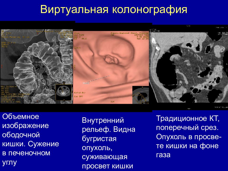 Виртуальная колоноскопия отзывы. Кт-колонография (виртуальная колоноскопия). Кт колонография толстой кишки. Колоноскопия опухоль ободочной кишки. Кт колонография кишечника.