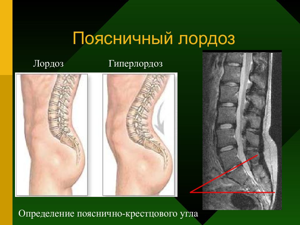 Гиперлордоз поясничного отдела позвоночника лечение