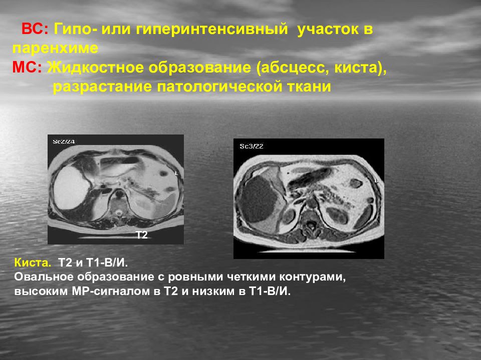 Признаки абсцесса печени на т1 взвешенных изображениях