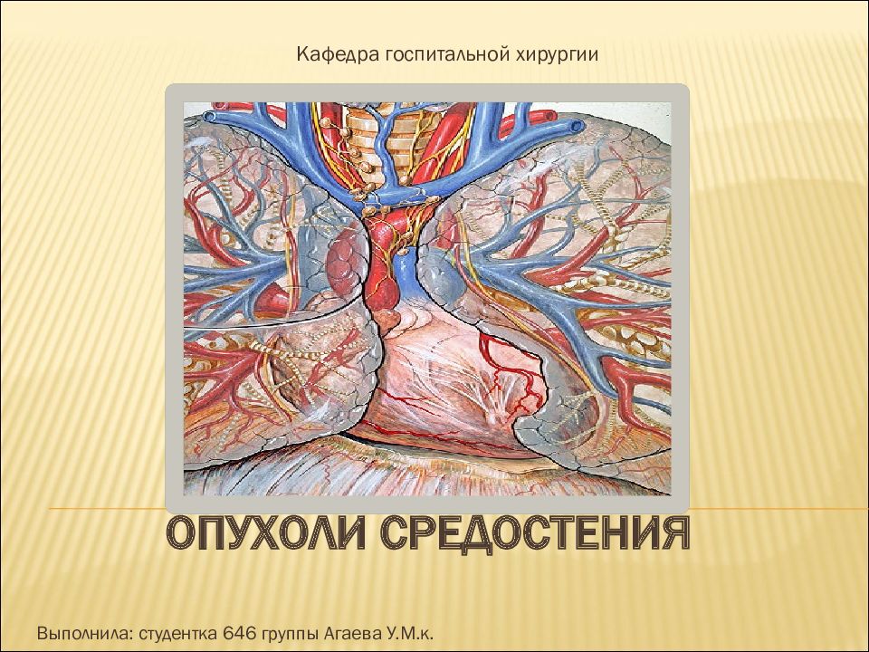 Опухоли средостения