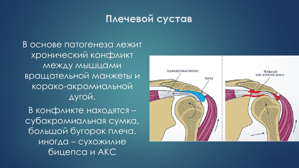 Плечевой сустав по форме. Субакромиальная сумка. Субакромиальная суставная сумка. Бугорок в плечевом суставе. Субакромиальное пространство плечевого сустава.