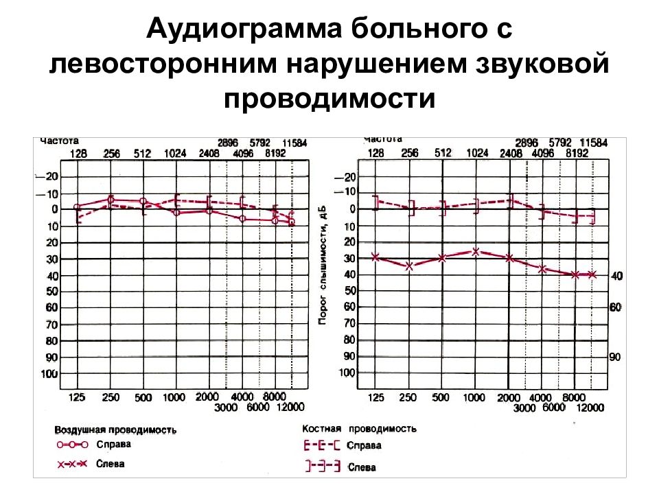 Графическое изображение на специальном бланке данных исследования состояния слуха проводимого с