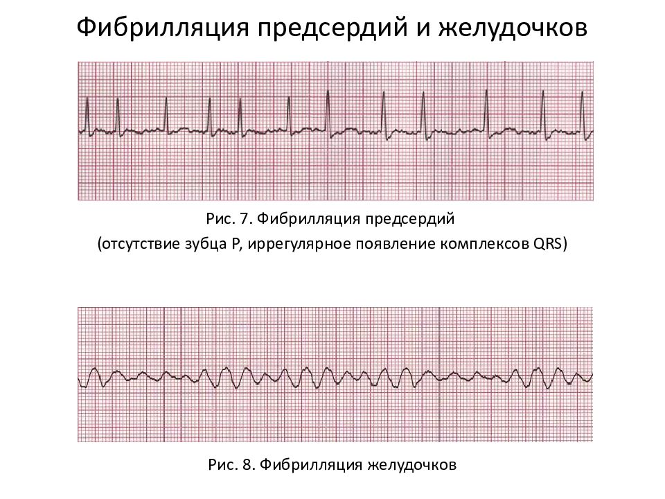 Пароксизм фп карта вызова