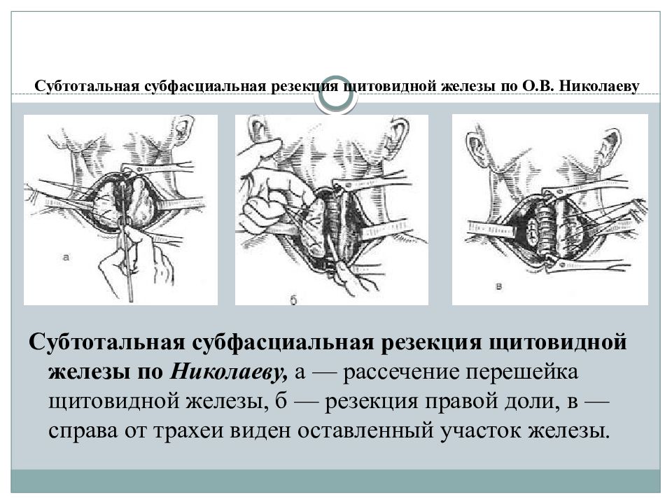 Секторальная резекция. Субтотальная резекция щитовидной железы. Субтотальная субфасциальная резекция. Эпифасциальная резекциящимтовидной железы. Субтотальная резекция щитовидной железы по Николаеву.