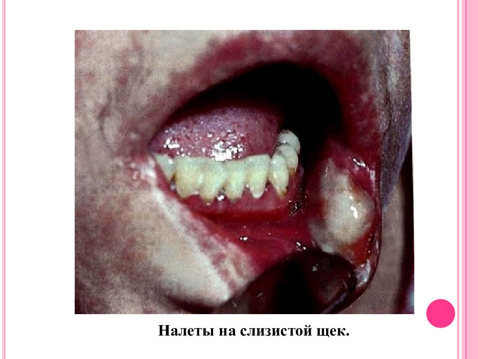 Токсическая форма дифтерии