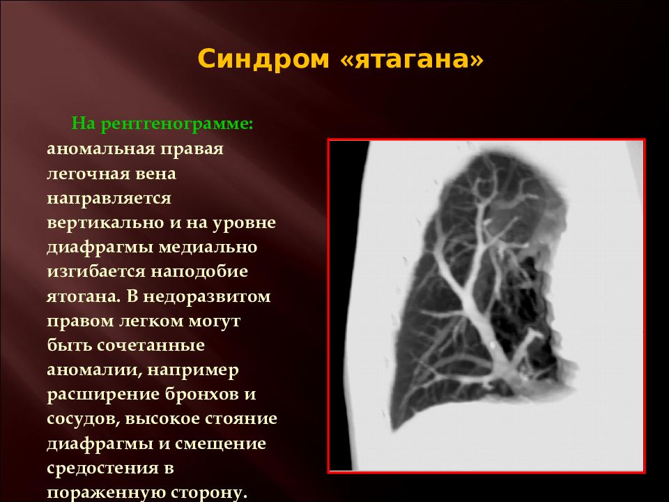 Заболевание аномалия. Симптом ятагана на рентгене. Синдром ятагана клинические рекомендации.