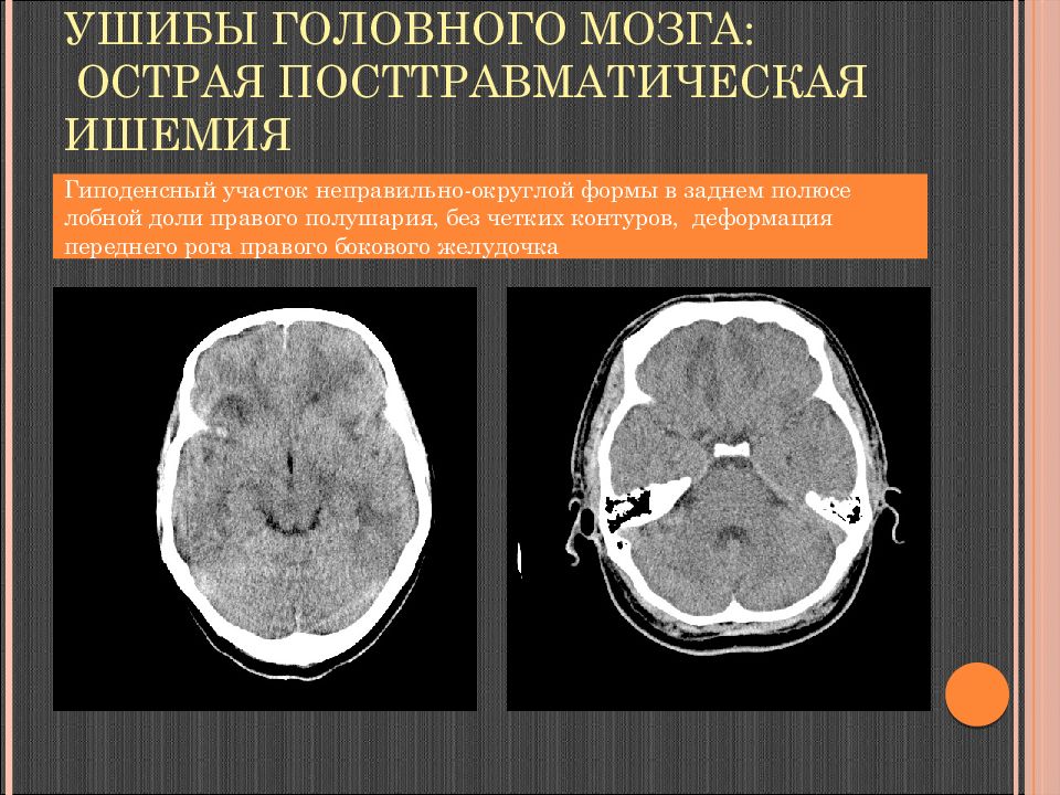 Очаг ишемии мозга. Посттравматические изменения головного мозга на кт. Ишемия головного мозга на кт. Гиподенсные очаги головного мозга на кт. Ишемические изменения головного мозга кт.