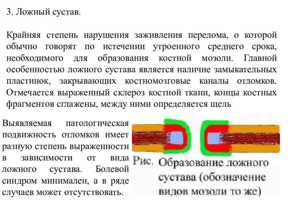 Оп это. Образование ложного хода.