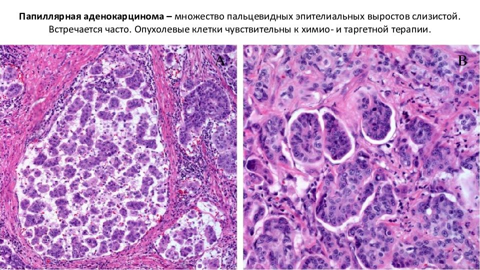 Злокачественная опухоль аденомы. Папиллярная аденокарцинома почки гистология. Папиллярная аденокарцинома желудка гистология. Карциноид поджелудочной железы гистология. Аденокарцинома гепатоидных желез.