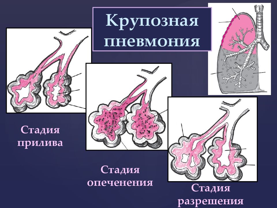 Картина вирусной пневмонии в стадии разрешения что это значит