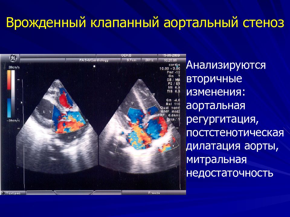 Что такое митральная регургитация