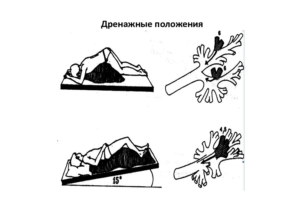 Дренажное положение квинке схема