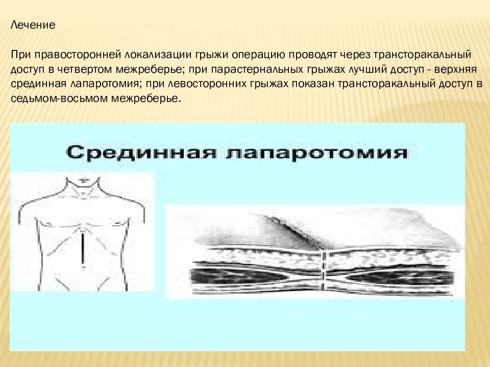 Диафрагмальные грыжи презентация хирургия