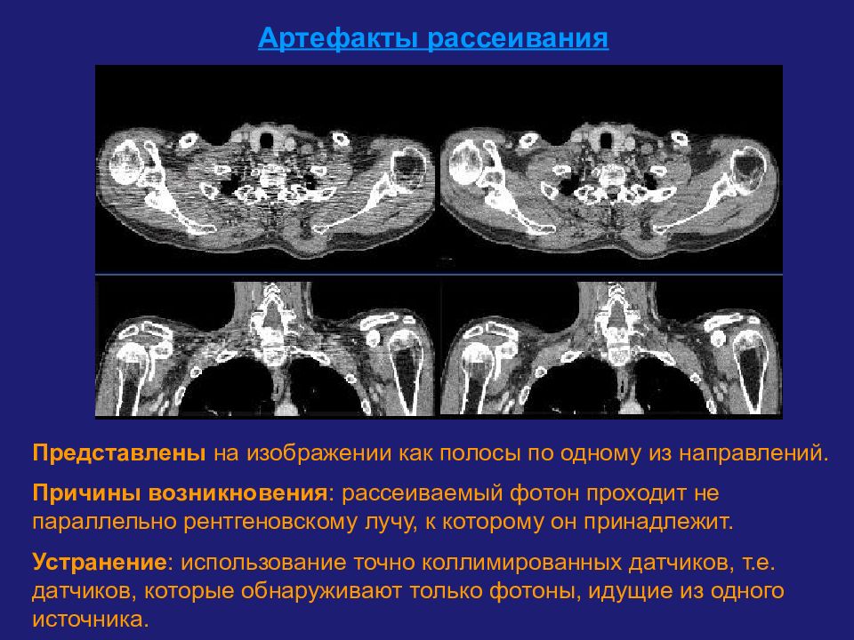 Артефакты кт изображений