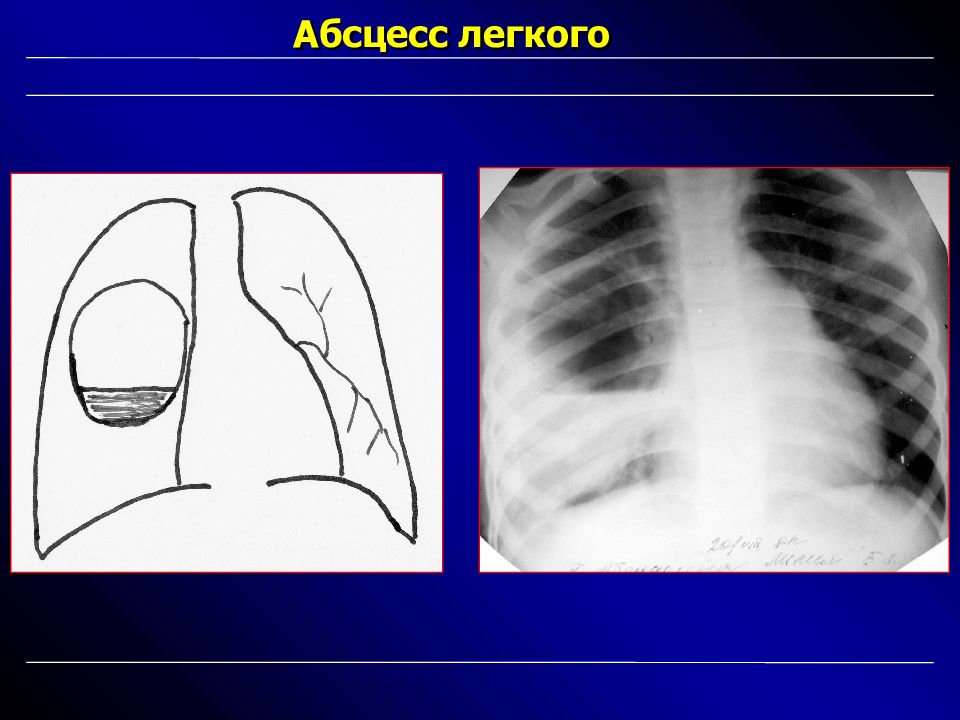 Абсцесс легкого рисунок