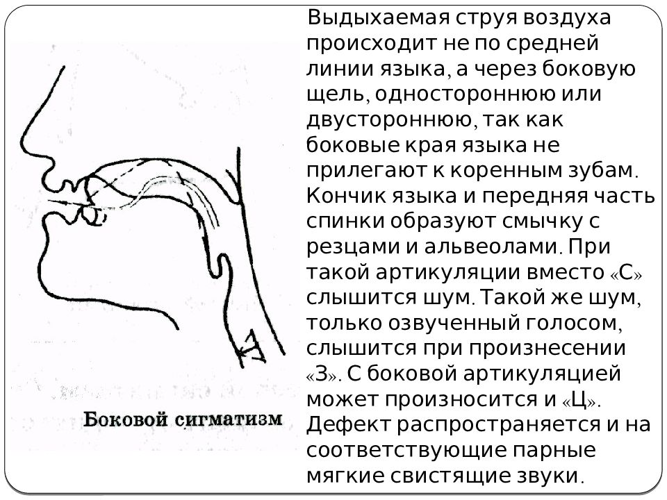 Парасигматизм шипящих Парасигматизм шипящих