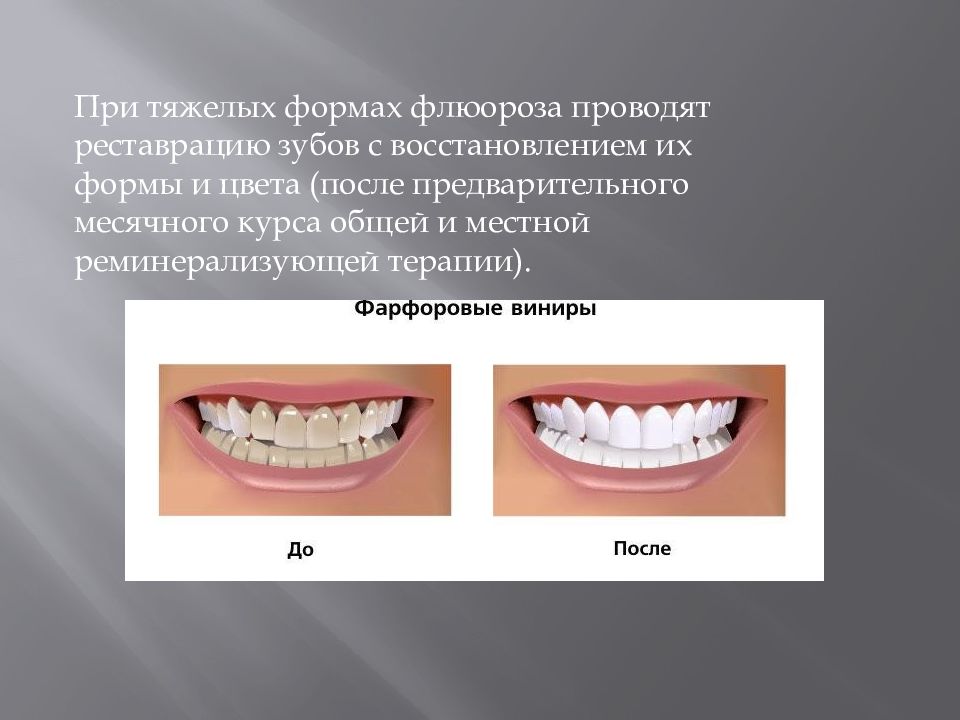 Флюороз у детей — презентация