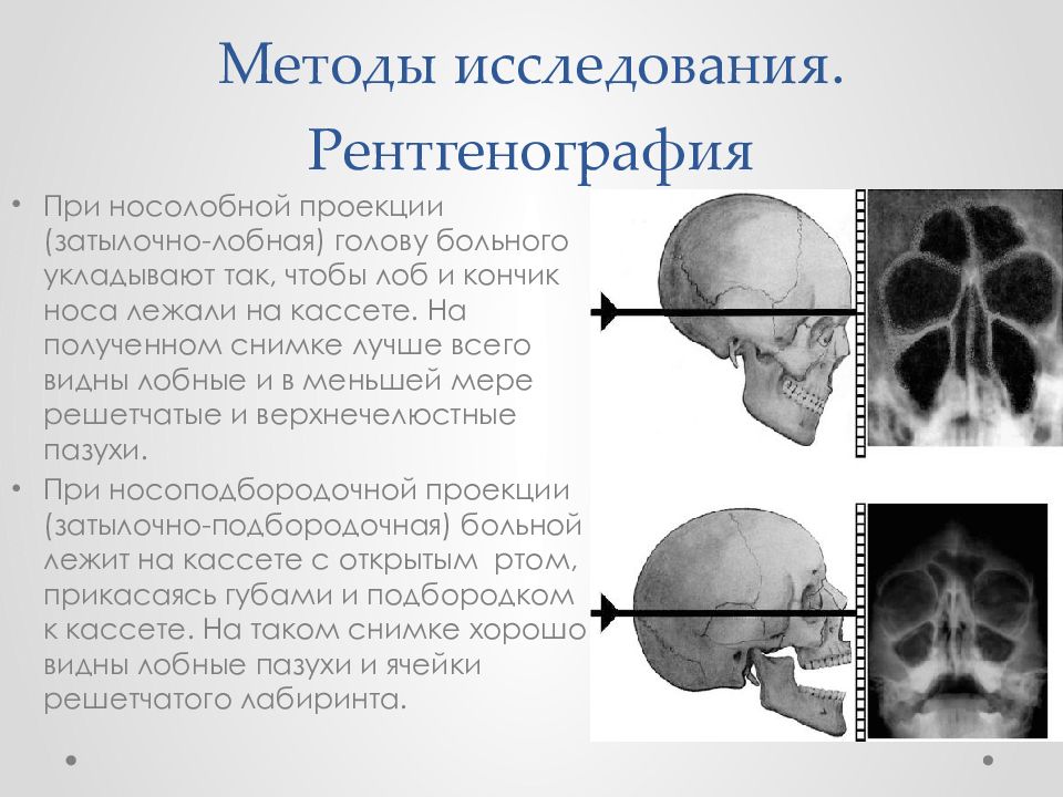 Лучевая картина при синуситах и кистах придаточных пазух носа