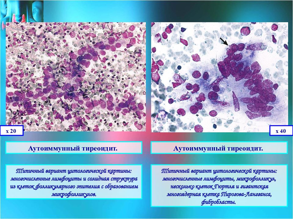 Щитовидная железа цитологическая картина. Цитологическая диагностика заболеваний желудка. Туберкулез щитовидной железы. Туберкулезный тиреоидит.