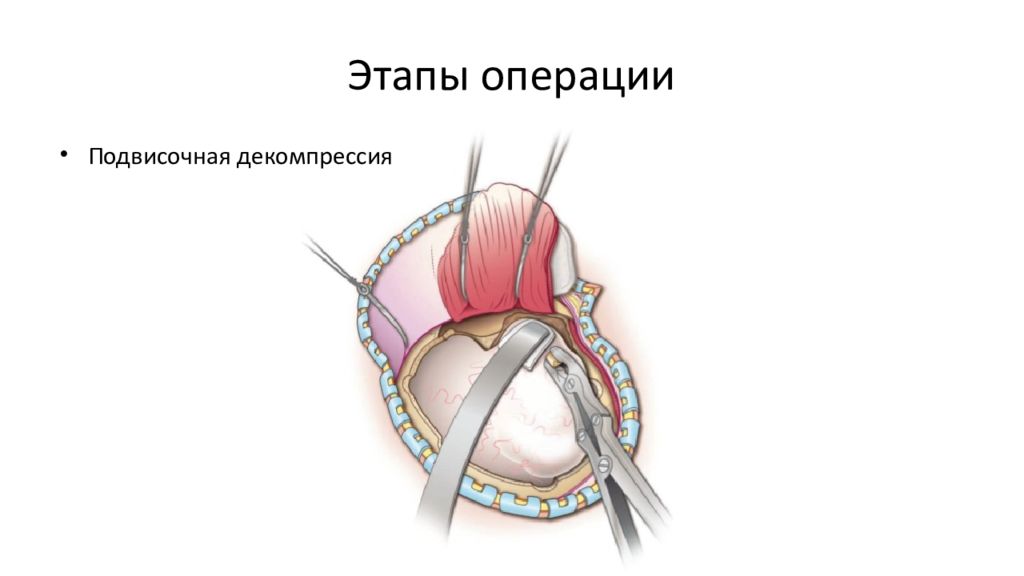 Этапы операции. Подвисочная декомпрессионная Трепанация. Декомпрессивная краниэктомия. Декомпрессия ямки черепа.