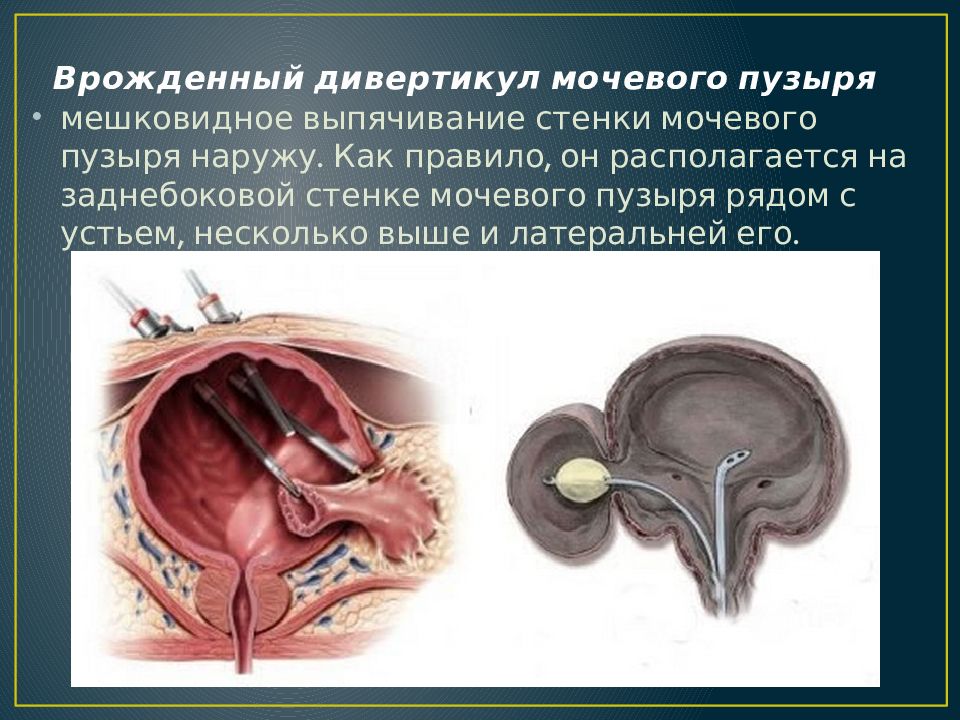 Несколько выше. Врожденный дивертикул мочевого пузыря. Псевдодивертикулез стенок мочевого пузыря. Множественные дивертикулы мочевого пузыря. Дивертикул верхушки мочевого пузыря.