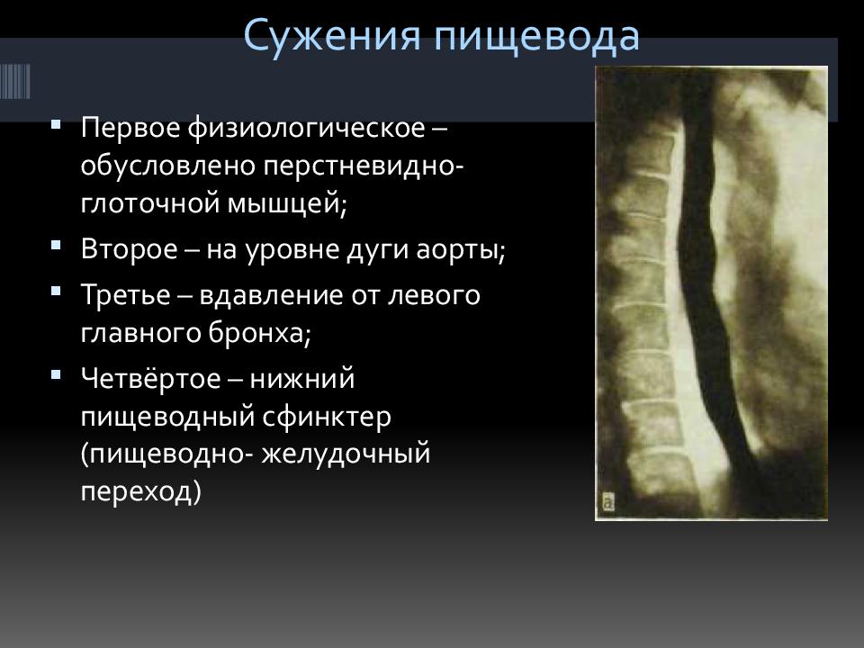 Признаки раннего рака пищевода. Рубцовые стриктуры пищевода. Рубцовое сужение пищевода рентген. Рубцовый стеноз пищевода. Циркулярное сужение пищевода.