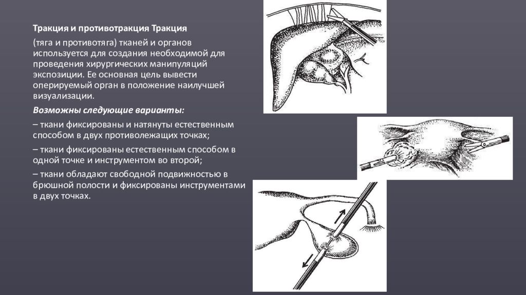 Операция главный. Лапароскопические манипуляции тракция. Принципы лапароскопической хирургии. Принципы проведения лапароскопических операций.