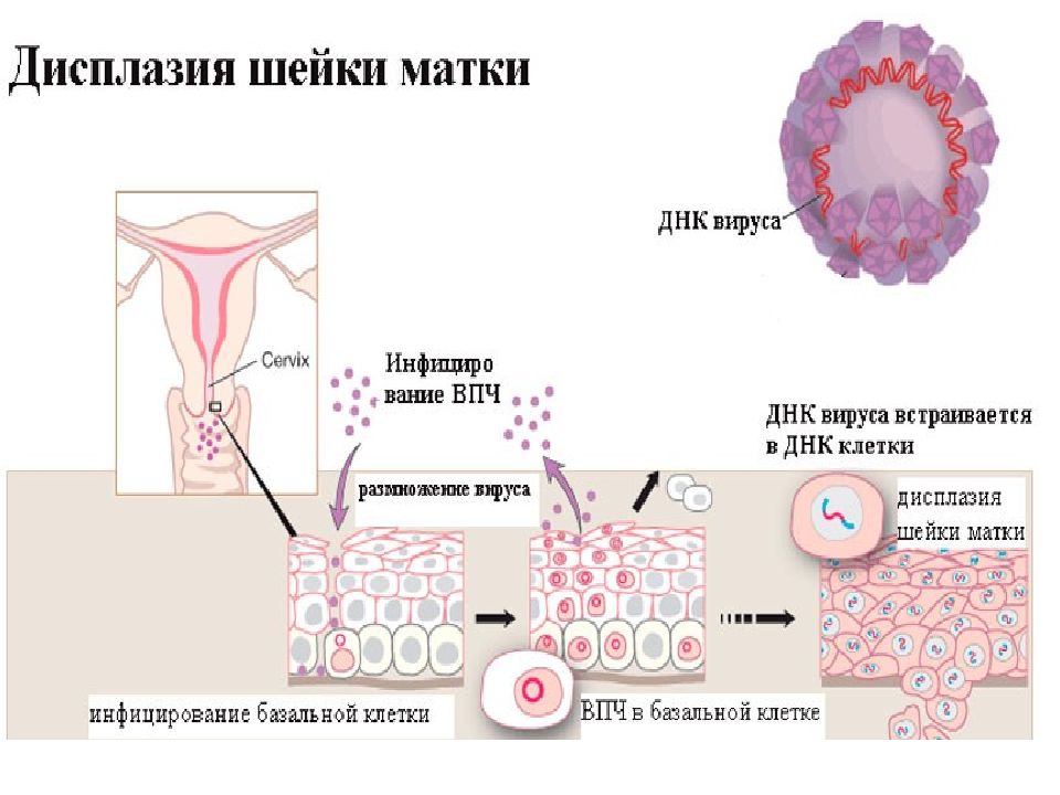 Схема лечения дисплазии шейки матки 1 степени