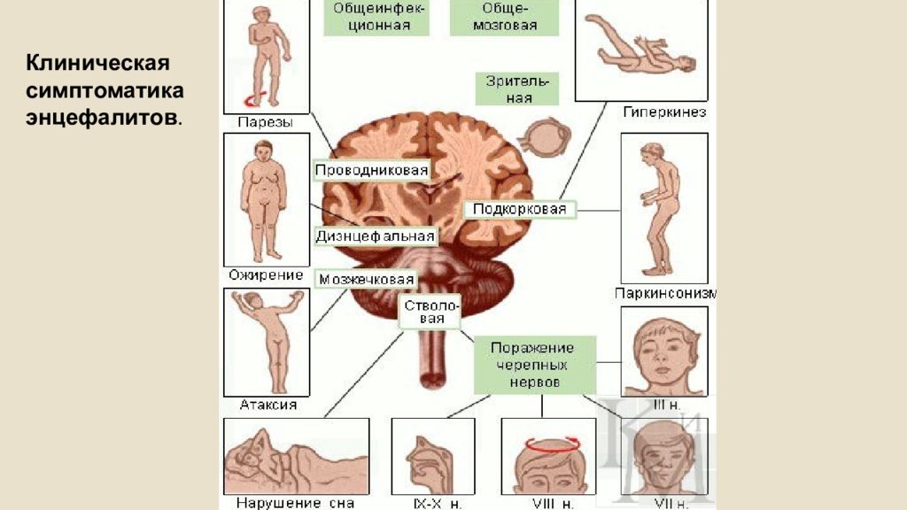 Воспаление мозга. Энцефалит симптомы неврология. Вирус клещевого энцефалита патогенез. Неврологические симптомы клещевого энцефалита. Симптомы менингеальной формы клещевого энцефалита.