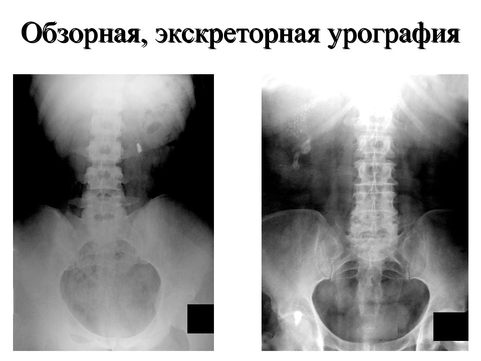 Экскреторная урография. Обзорная и экскреторная урография. Обзорная урография. Обзорная выделительная урография. Обзорная урография презентация.