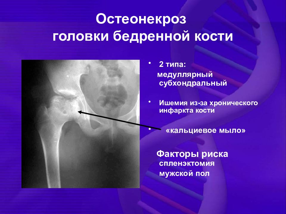 Некроз шейки бедра. Асептический некроз шейки бедренной кости на рентгене. Аваскулярный некроз головки бедренной кости. Асептический (аваскулярный) некроз кости. Асептический некроз коленного кости.