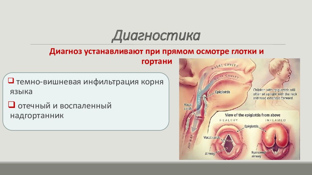 Острая дыхательная недостаточность у детей презентация