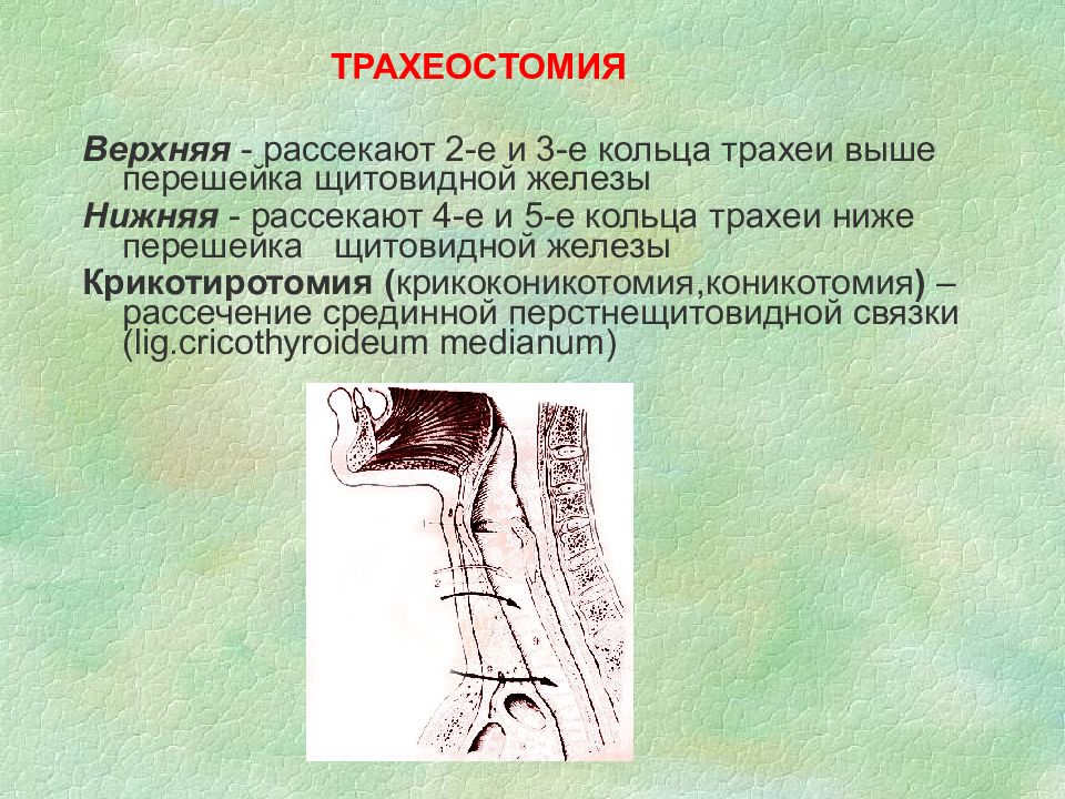 Наложение трахеостомы. Верхняя трахеостомия топографическая анатомия. Трахеостомия рассечение колец трахеи. Нижняя трахеостомия топографическая анатомия.