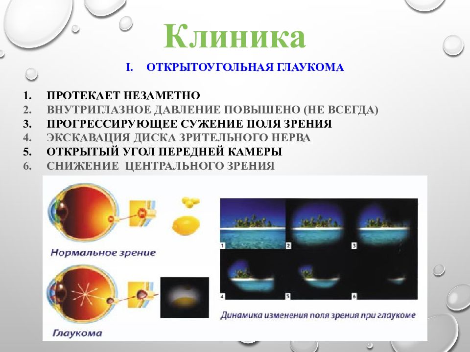 Открытоугольная глаукома. Открытоугольная глаукома профилактика. Глаукома сужение полей зрения. Профилактика глаукомы памятка. Откурто угольна глауком а.