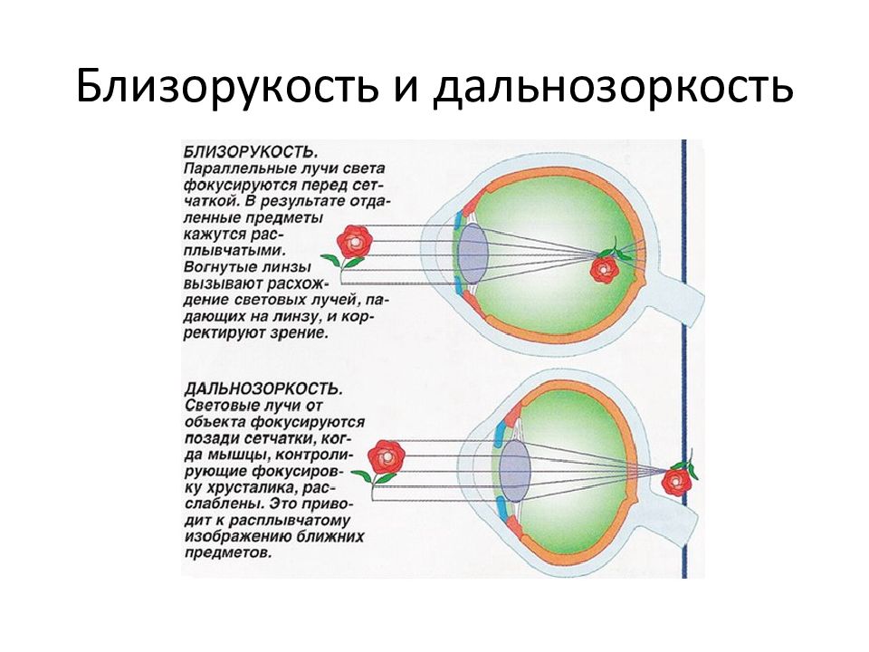 Органы чувств анализаторы тест. Схема близорукости и дальнозоркости. Рисунок близорукости и дальнозоркости. Близорукость и дальнозоркость. Приобретенная миопия.