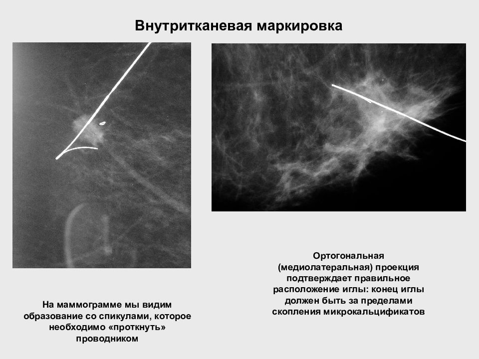 Квадранты молочной железы схема