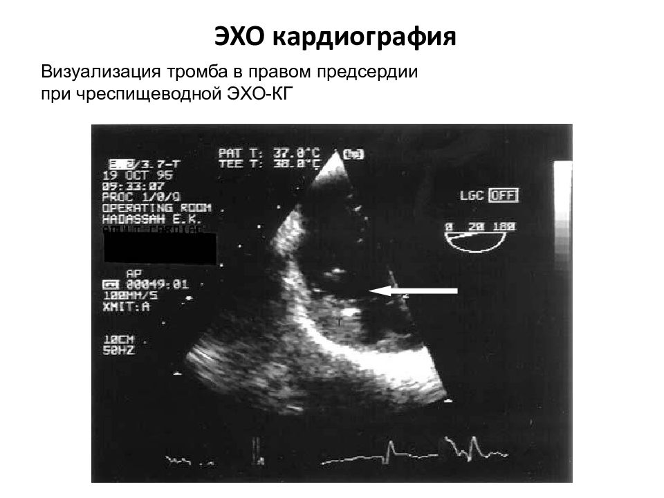 Эхо кардиография. Тромб в левом предсердии ЭХОКГ. Чреспищеводная эхокардиография. Ушко левого предсердия ЭХОКГ.