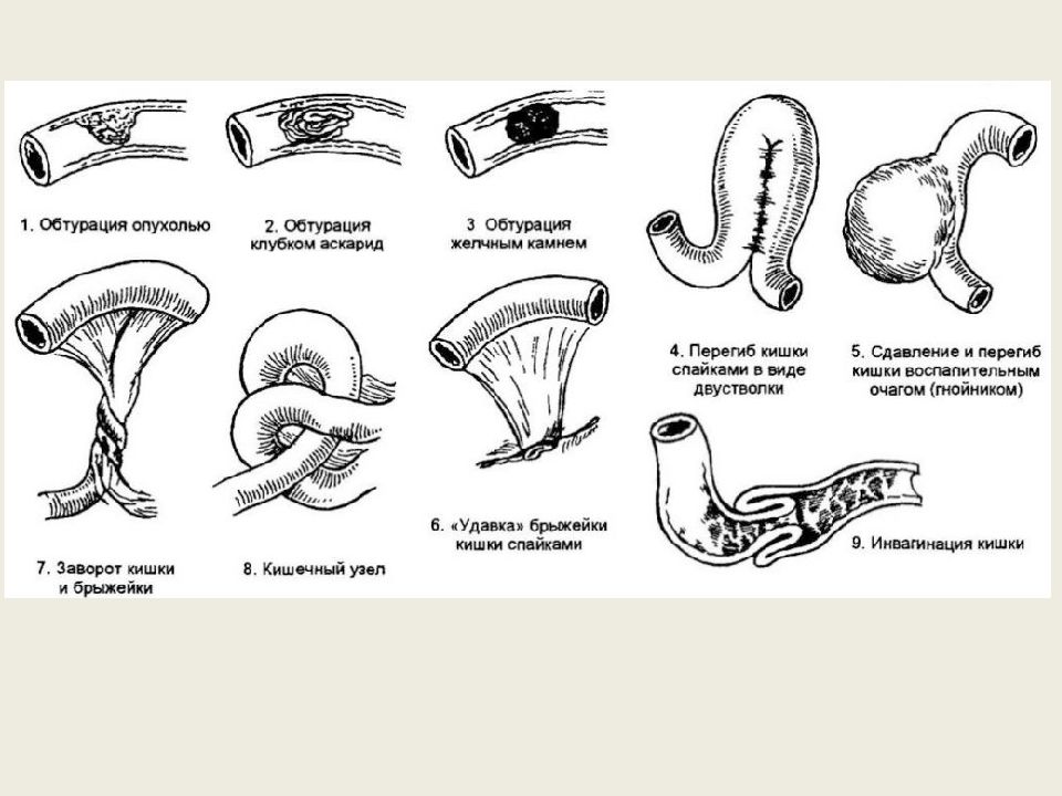 Кишечная непроходимость патофизиология презентация