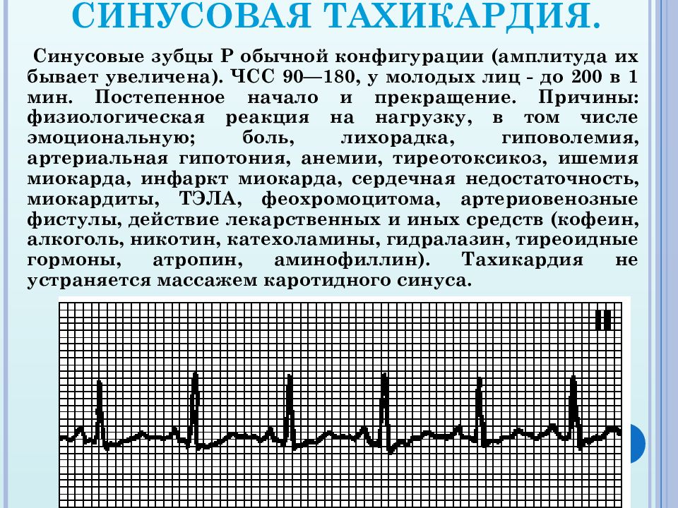 Тахикардия в покое. ЭКГ при синусовой тахикардии сердца. Синусовая тахикардия ЭКГ расшифровка. ЭКГ при синусовой тахикардии в норме. Синусовая тахикардия ЭКГ 2 отведение.