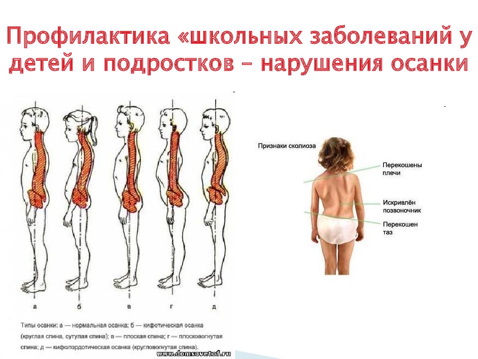 Сколиотическая осанка. Предупреждение нарушений осанки. Профилактика осанки. Болезни при нарушении осанки. Профилактика при искривлении позвоночника.