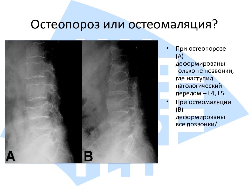 Патологический перелом. Диффузный остеопороз позвоночника рентген. Остеопороз рентген признаки. Рентгенодиагностика остеопороза.