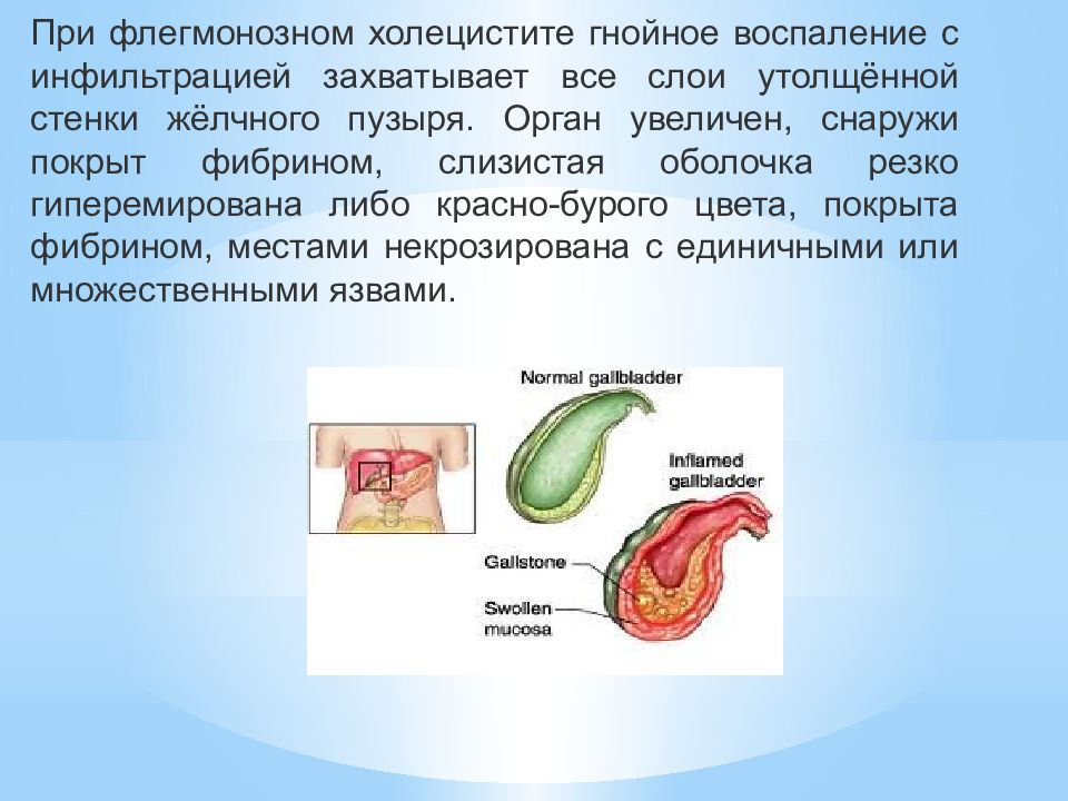 Острый калькулезный холецистит презентация