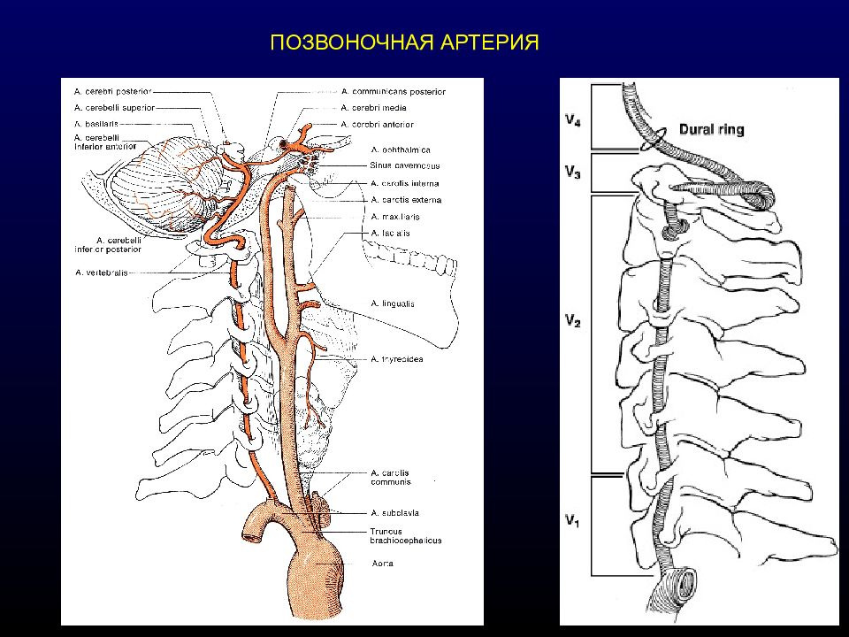 Сегмент артерии. Сегмент v1 позвоночной артерии. V4 сегмент позвоночной артерии. Сегмент v1 v2 позвоночной артерии. Сегменты позвоночных артерий анатомия.