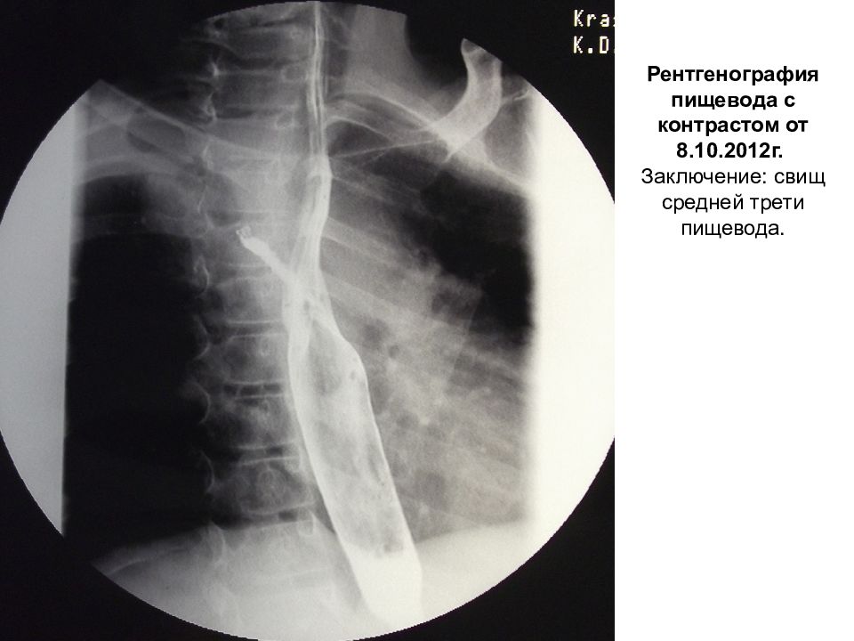 Рентгеноскопия пищевода. Рентгеноконтрастное исследование пищевода. Рентген грудной клетки с контрастированием пищевода. Контрастирование пищевода рентген.