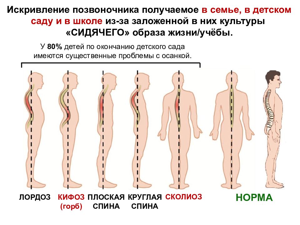 Искривление позвоночника картинки